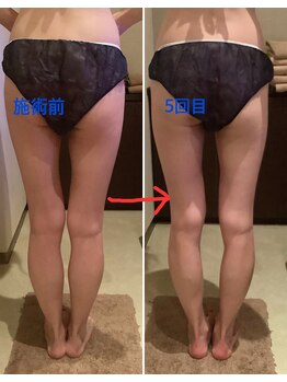 クレアボディ(CREA BODY)/太ももふくらはぎ