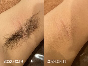 ウルル 栄店(ULULU)/ワキ脱毛の症例♪