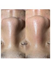 ミユサロン(Miu-salon)/韓国式3D毛穴洗浄