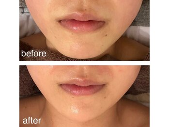 シェノン(Chainon)/顎スッキリ