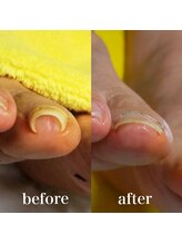 ドクターネイル爪革命 札幌大通店/症例紹介　巻き爪