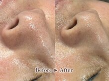 リテルナ(Re.terna)/■毛穴洗浄・毛穴ケアコース