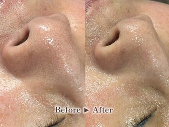 リテルナ(Re.terna)/■毛穴洗浄・毛穴ケアコース