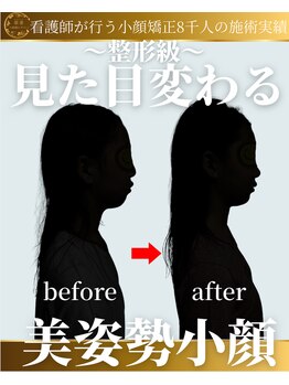 顔凛(カオリン)/見た目が変わる小顔矯正