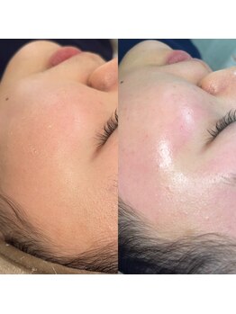 ヴィヴ 熊本(ViV)/フェイスWAXで自然な艶肌に