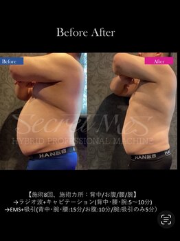 メルシー(Merci)/男性に多いポッコリお腹にも。