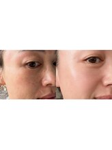 ラグラン銀座メディカルエステ 高輪ゲートウェイ店/毛穴除去/肌質改善に♪