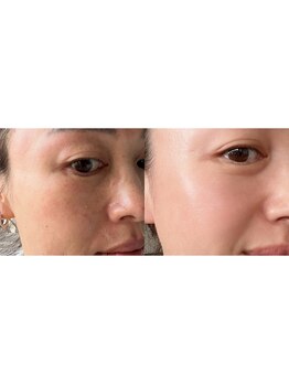 ラグラン銀座メディカルエステ 高輪ゲートウェイ店/毛穴除去/肌質改善に♪