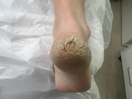 フットケア★ビフォーアフター★