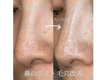 フルール ニコ(Fleur Nico)/毛穴洗浄×ハーブピーリング