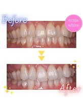 エクシアホワイト 山形西バイパス店/ビフォーアフター