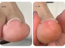 ロンディネ(Rondine)/巻き爪ケア&ネイルトリム27