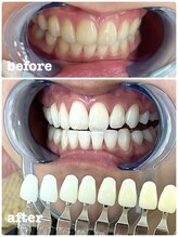 エクシア ホワイトニング 富山店/ビフォーアフター写真☆