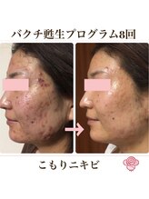 シエル(Ciel)/次世代レチノール《バクチ甦生》