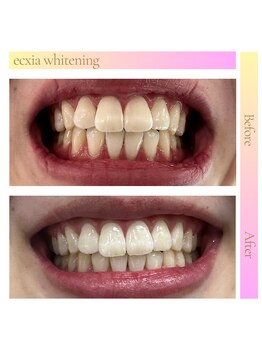 エクシアホワイトフジ(ecxia white fuji)/ホワイトニングビフォーアフター