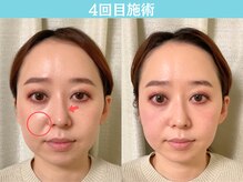 ナチュラルパーフェクトフェイス 新宿/4回目施術