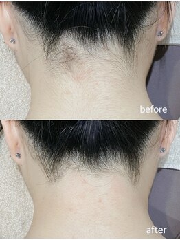 エムズスタイル ネイルバー(M's Style NAIL BAR)/うなじ脱毛ビフォーアフター