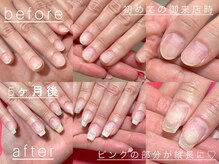 スマイル ネイル ラボラトリー(Smile nail laboratory)の雰囲気（初御来店から5ヶ月経過。ピンクの部分が縦長に育成☆）