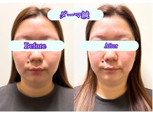 フラット柏(FLAT柏)/美容鍼BeforeAfter