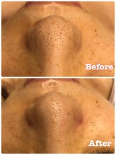 バナナ 福井店(Banana)/毛穴洗浄ビフォーアフター