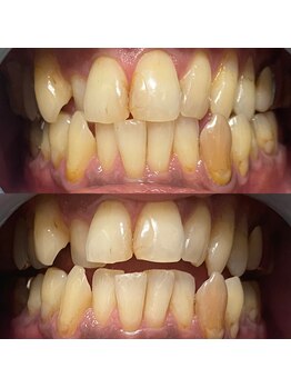 サロン ド ルナ(Salon de Luna)/セルフホワイトニング