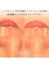 エスプリ 銀座店/ハーブピーリングI銀座