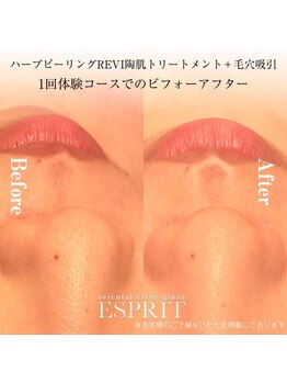 エスプリ 銀座店/ハーブピーリングI銀座