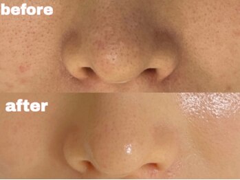 サゥオルサロン(sawalsalon)/セラピール症例【美肌/艶肌】