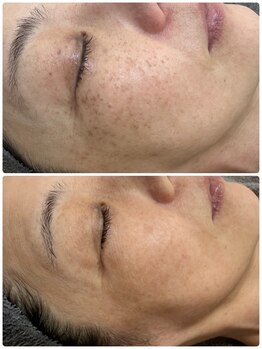 ベルフィーヌ ノーブル(BELLEFINE noble)/当店大人気のシミケア