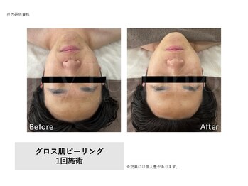 トータルクリア(TOTAL CLEAR)/Gloss肌ピーリング