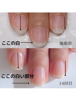 プライベートネイルサロン ママネイル(mamanail)/最強のネイルケア★お客様症例