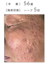 リベル 名古屋(Lebelle:)/ハーブピーリング　名古屋