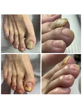 ドクターネイル爪革命 十条店/肥厚爪ケア