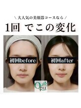 キュープ 富士店(Qpu)/美肌もお任せください♪小顔矯正
