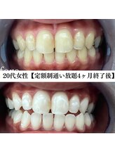 ホワイト 福岡博多店(WHITE)/ホワイトニングビフォーアフター