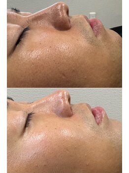 ラニー アンド ココネイル(LANIE&CocoNail)/毛穴汚れスッキリ！　毛穴ケア