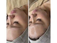 フィフ(fif)/JETPEELフル(ヒアルロン酸)