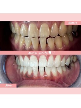 エクシアホワイトニング 札幌琴似店/ホワイトニングビフォーアフター
