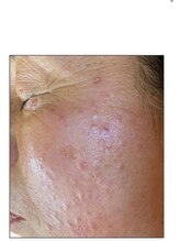 リベル 名古屋(Lebelle:)/ハーブピーリング　名古屋