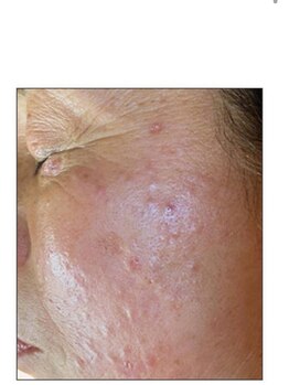 リベル 名古屋(Lebelle:)/ハーブピーリング 名古屋