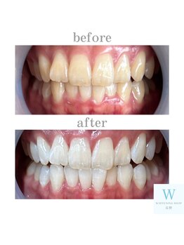 ホワイトニングショップ 長野店/自信を持って笑える様に♪