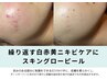 【白赤黄ニキビケア】皮脂,常在菌,角層チェック付スキングローピール¥9,900