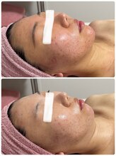 アンヘル(Angel)/ニキビケアはお任せ