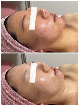 アンヘル(Angel)/ニキビケアはお任せ