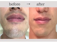 アネーロ(anhelo)/大人気のヒゲ脱毛！