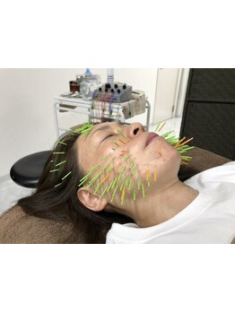 鍼灸施術を受けたい