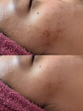 リートライ(Re Try)/ハーブピーリング