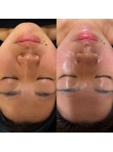 【ハーブピーリング/毛穴洗浄/小顔リフト】total beauty salon mayahime 大宮店/REVIハーブプーリング