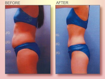 ジュリア オージェ 京橋店/ビフォーアフター(脂肪燃焼)