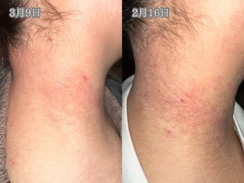 レイル(REIR)/皮膚悩みのある方必見★